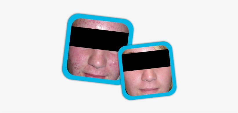 Acne Scars Result3 Acne Scars Result1 Acne Scars Result2 - Acne, transparent png