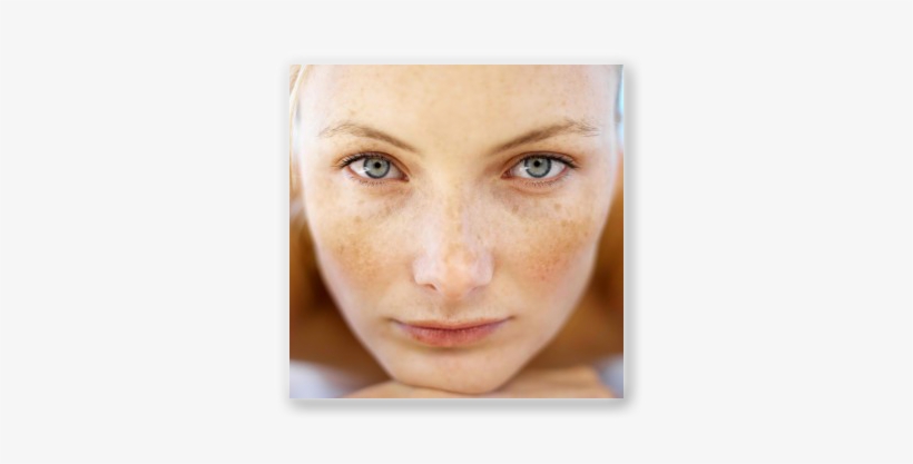 Preventing Early Acne Scars - Spots Due To Sun Exposure, transparent png