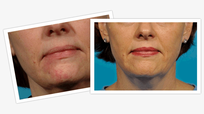 Laser Treatment Of Facial Veins In Michigan - Laser Surgery, transparent png