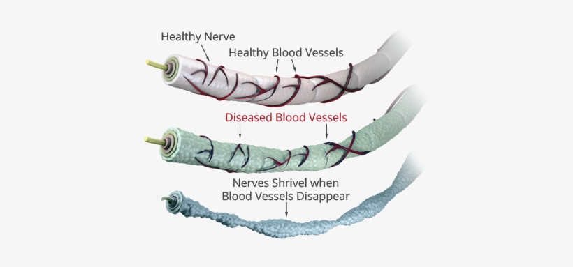 Neuropathy - Peripheral Neuropathy Nerve Damage, transparent png