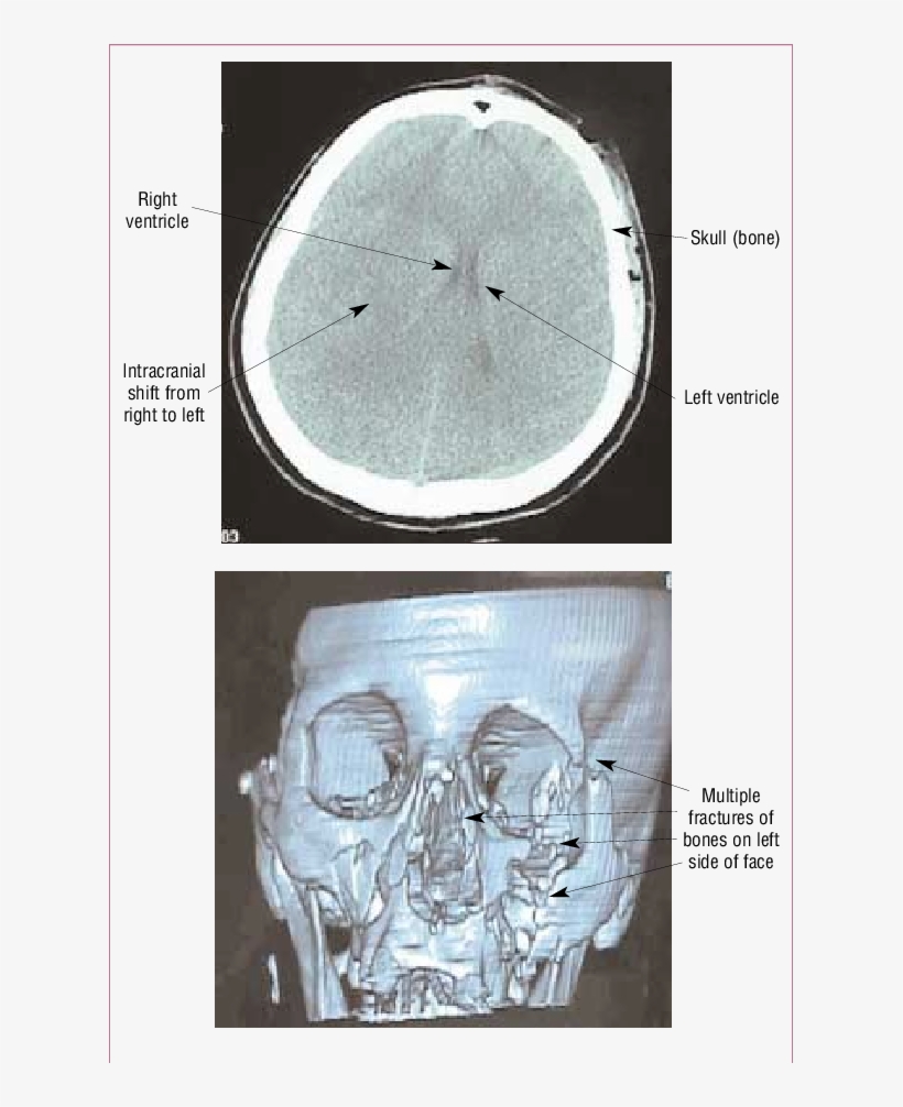 Unenhanced Ct Scans Of A - Computed Tomography, transparent png