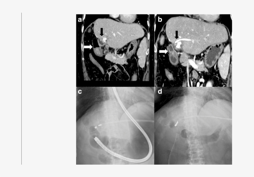 A Computed Tomography Showed The Bulbus Duodeni And - Bile Duct, transparent png