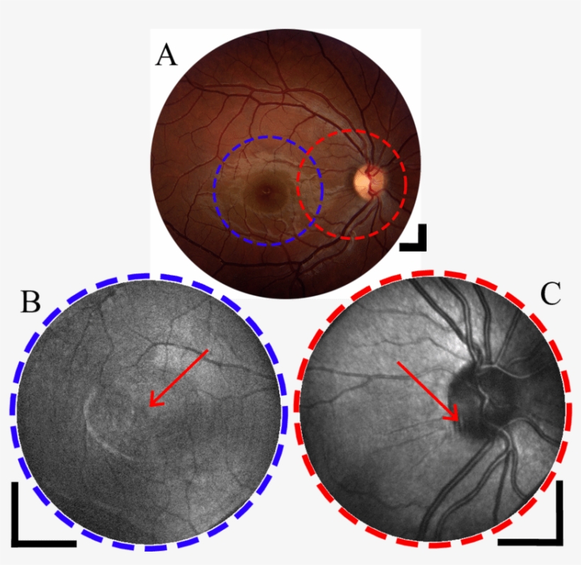Fundus Photograph Of Subject 2 Showing The Macular - Kurbside Kitchen, transparent png