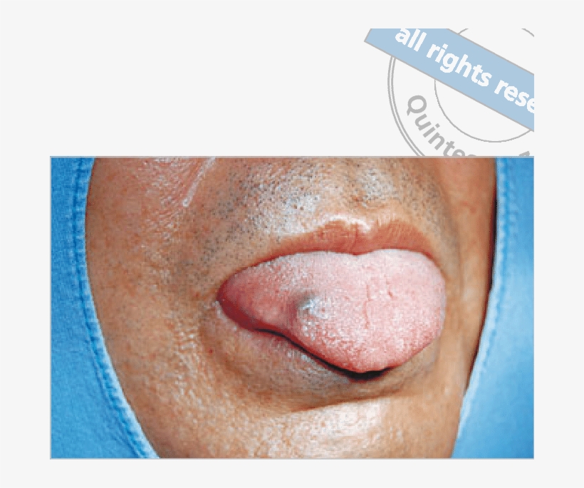 Purple Nodule Located On The Right Dorsum Of The Tongue - Purple Lump On Tongue, transparent png