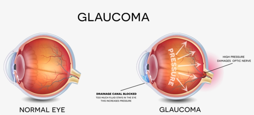 Image Result For Glaucoma - Glaucoma Eye, transparent png