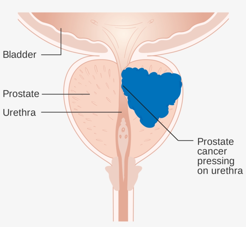 Prostate Cancer Exhibits Few Signs Or Symptoms - Prostate Cancer Androgen Receptor, transparent png