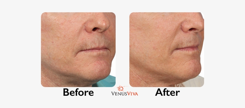 Learn More About Venus Viva™ - Venus Viva Before And After, transparent png