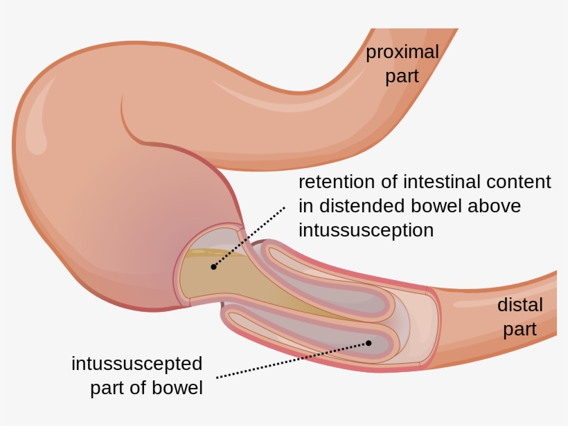 Http - Bowel Intussusception, transparent png