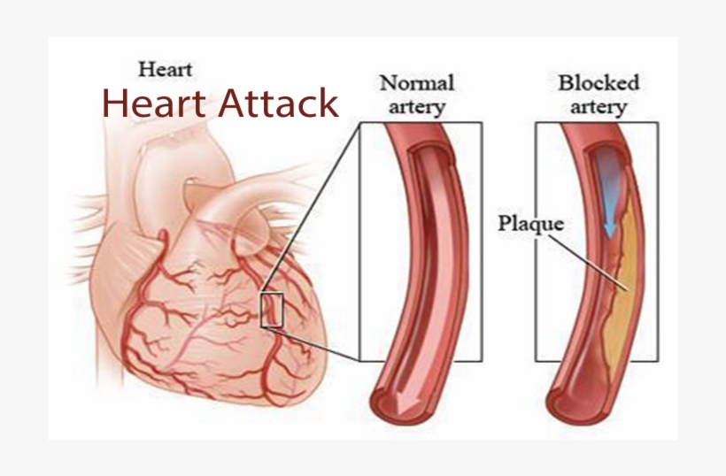 Coronary Artery Disease คือ, transparent png