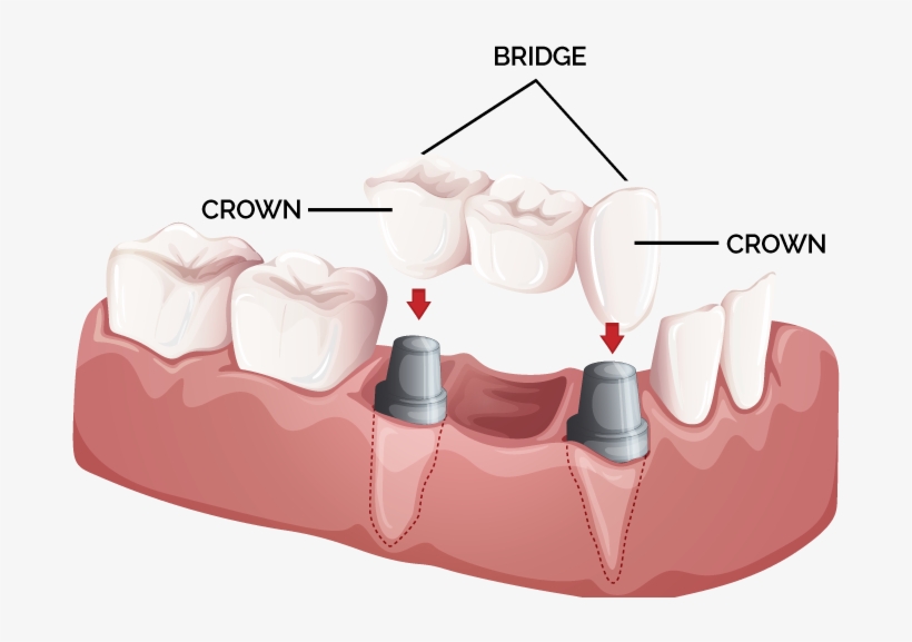 Crowns & Bridges - Dental Crowns And Bridges, transparent png