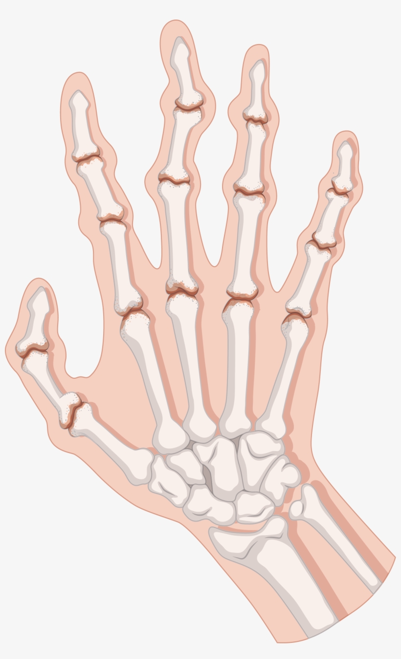 Rheumatoid Arthritis Clip Art - Arthritis Clipart, transparent png