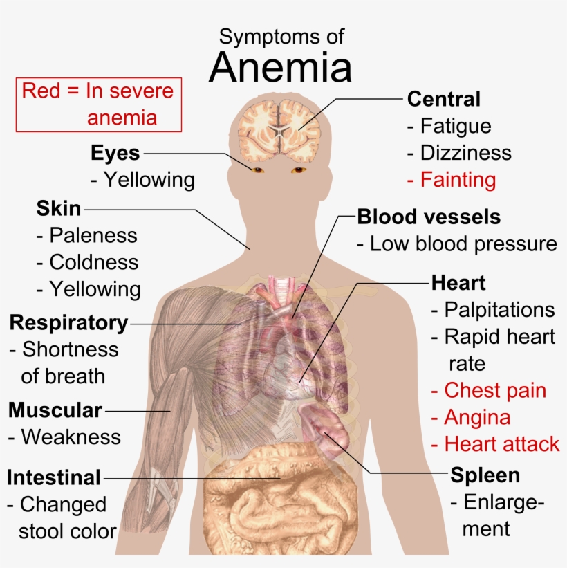 Symptoms Of Anemia Know If You Re Anemic 3273x3085 PNG Download
