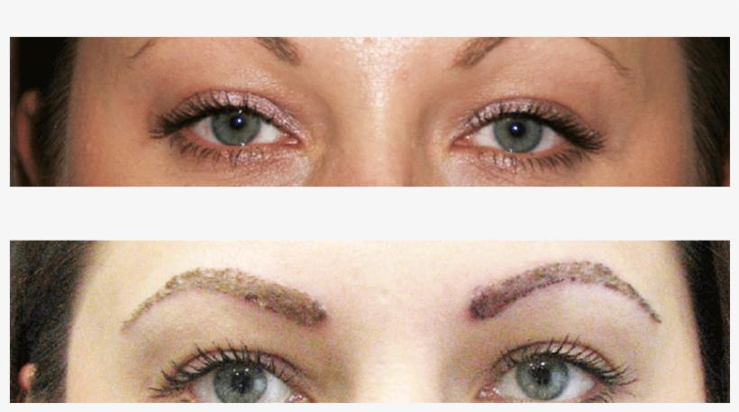 Trasplante De Cejas Antes Y Después - Eyebrow, transparent png