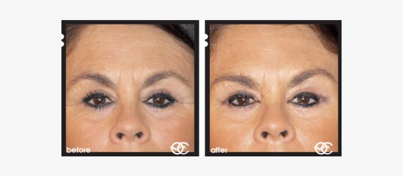 Before And After Botox - Does Botox Work, transparent png