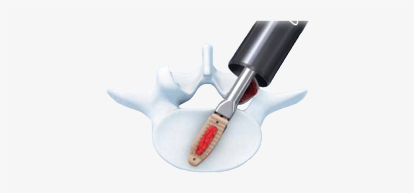 Opal Spacer System - Opal Synthes, transparent png