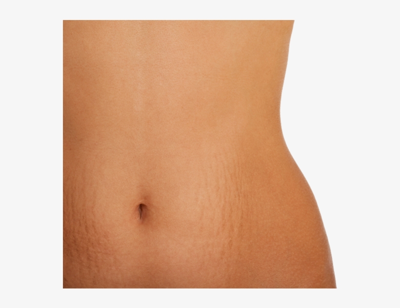 Stretch Marks Are Often The Result Of The Rapid Stretching - Mild Stomach Stretch Marks, transparent png