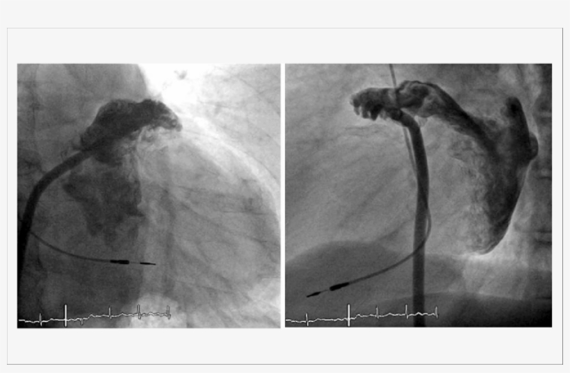 Magens Angiográficas Do Apêndice Atrial Esquerdo, Em - Left Atrial Appendage, transparent png