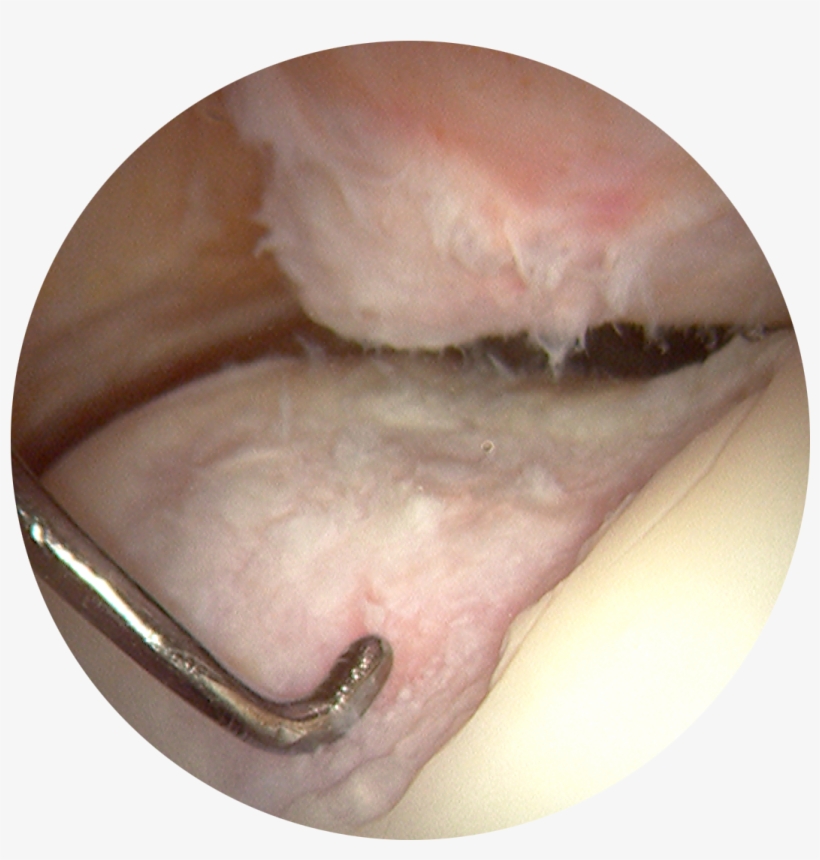 Knee Injuryand Osteoarthritis Outcome Survey Results - Arthroscopic View Of Knee Osteoarthritis, transparent png