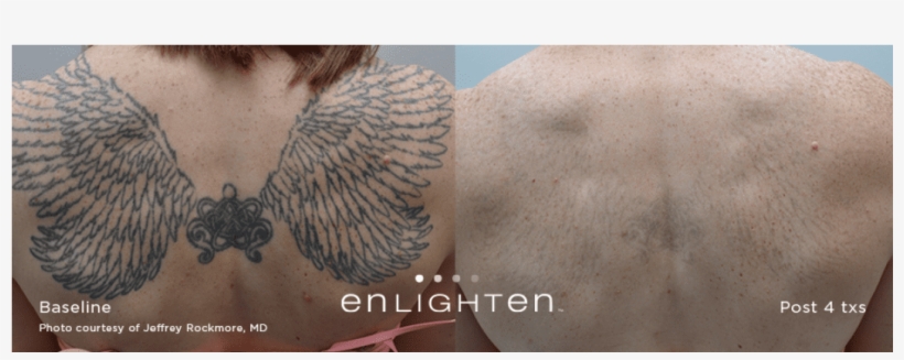 Tattoo Removal* - Tattoo Removal, transparent png