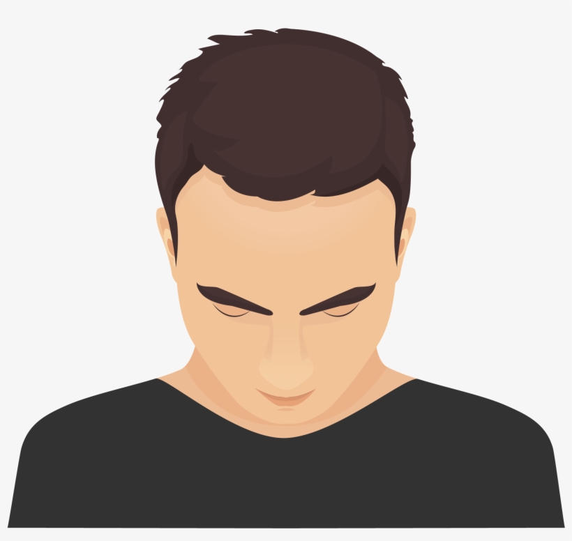 Type 1 - - Pattern Hair Loss, transparent png