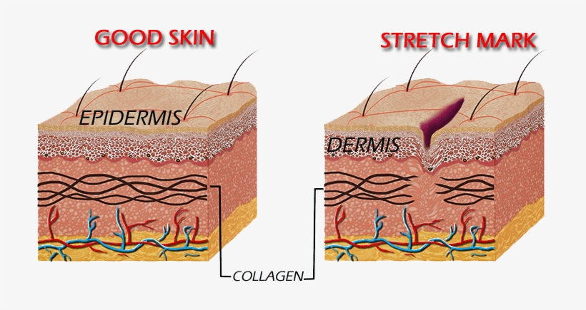 Alteration Of The Dermis, Gives Rise To Stretch Marks - Stretch Marks Cause, transparent png