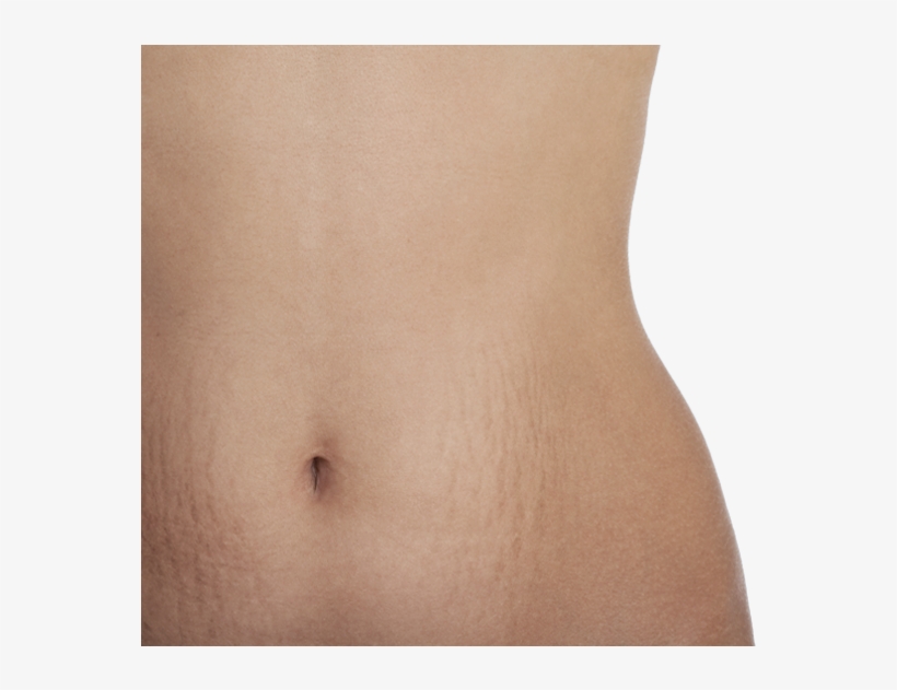Luckily, Not Everyone Develops Stretch Marks - Navel, transparent png