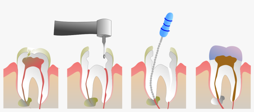 Chico Dentist Root Canal - Root Canal Therapy, transparent png
