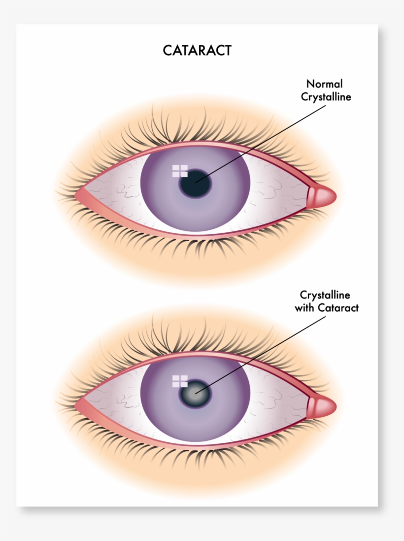 Cataract Symptoms - Redness In Conjunctiva, transparent png