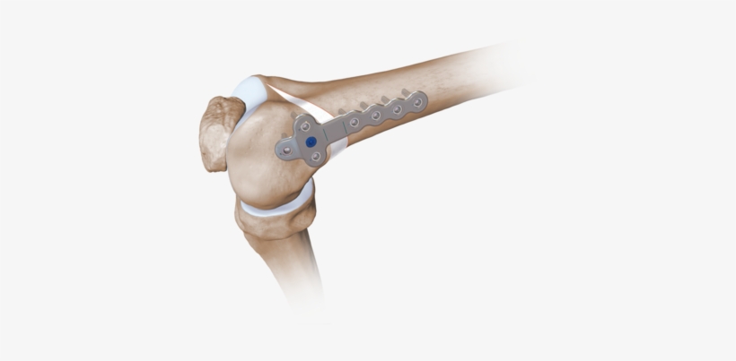 Femoral Opening Wedge Osteotomy Plates 0 Large - Arthrex Distal Femoral Osteotomy, transparent png