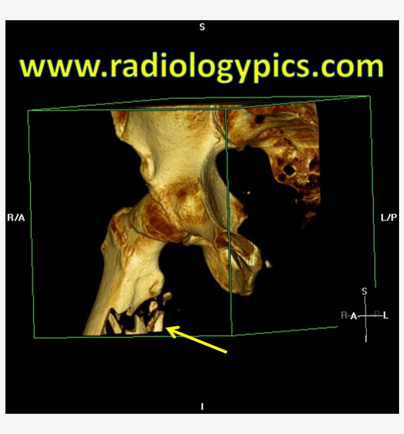 Subtrochanteric Femur Fracture - Millenium Development Goal 7, transparent png
