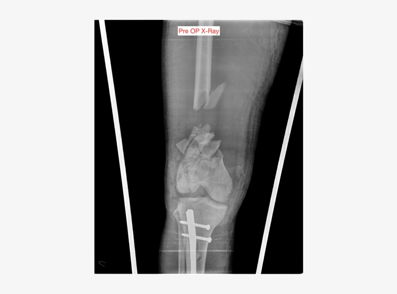 21-year Old Male With Compound C3 Fracture Of The Right - Bone Fracture, transparent png