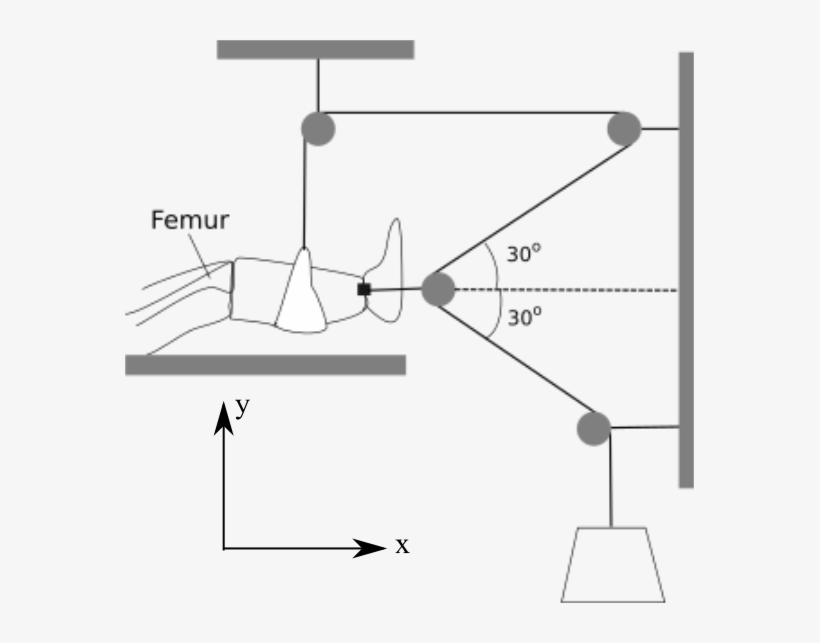 Femur 30° 30° - Force, transparent png