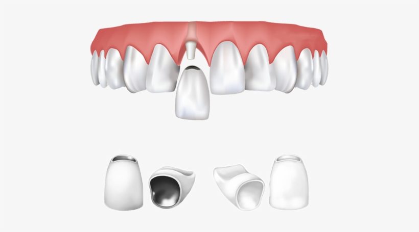 Dental Crowns Types - Dental Crown Png, transparent png