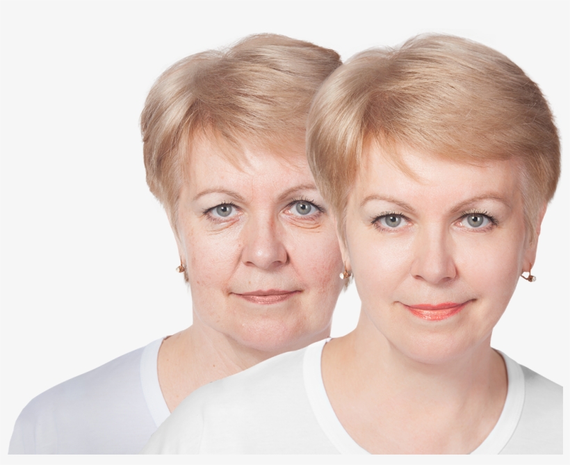 Before And After Image Of Woman's Face After Plastic - Plastic Surgery, transparent png