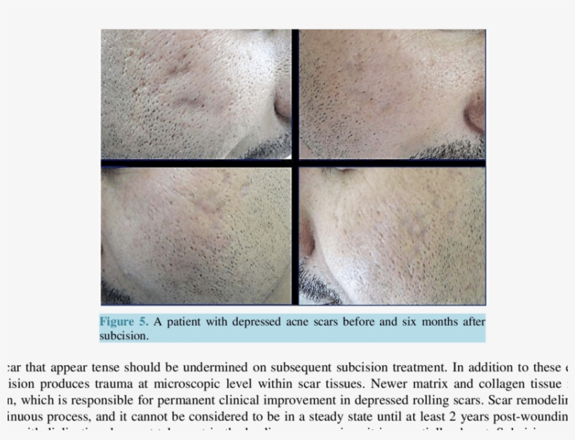 A Patient With Rolling & Icepick Acne Scars Before - Acne, transparent png