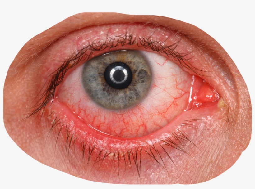 Sign In To Save It To Your Collection - Herpes On Tear Duct, transparent png