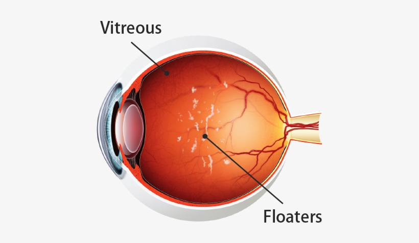 What Are The Symptoms Of A Retinal Detachment - Kodak Uv Blue Lens, transparent png