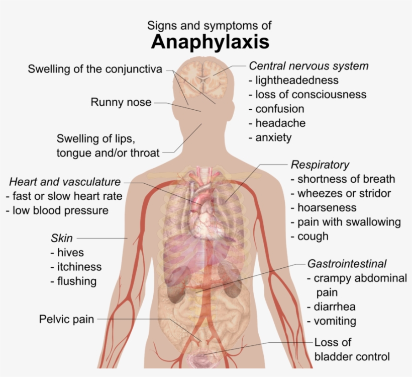 There Are Many Possible Signs Of Anaphylaxis - Anaphylactic Shock, transparent png