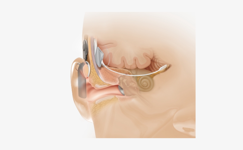 Anatomical View Showing Abi Placement, Which Bypasses - Implante De Tronco Cerebral, transparent png