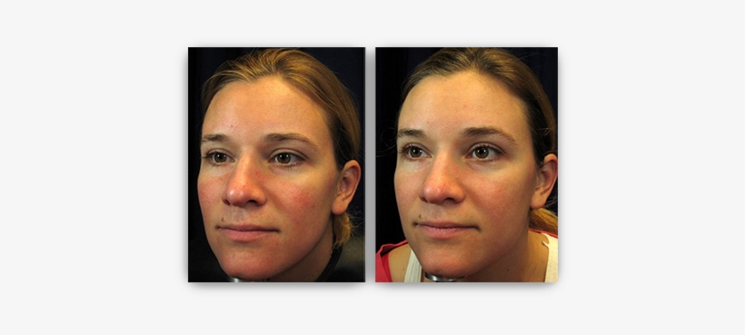 Safely Eliminating Blue Vessels Near The Eye - Laser Treatment For Redness, transparent png