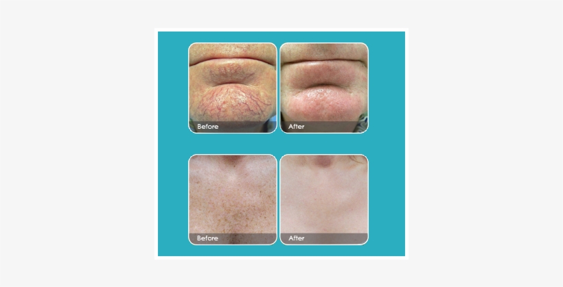 South Florida Vein Aesthetics - Laser, transparent png