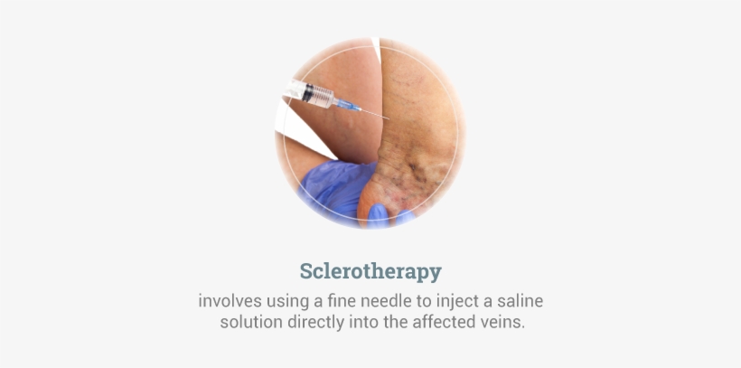 Sclerotherapy - Earth, transparent png