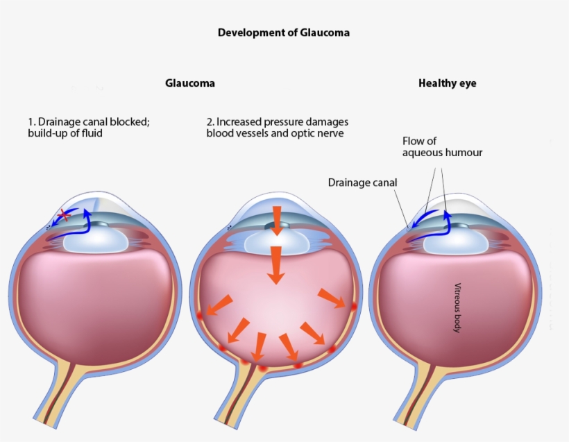Ophthalmic G-probe™ - Laser Cycloablation, transparent png