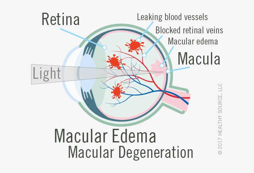 Bleeding, Leaking, And Scarring From The Damaged Blood - Blood Supply To Macular, transparent png