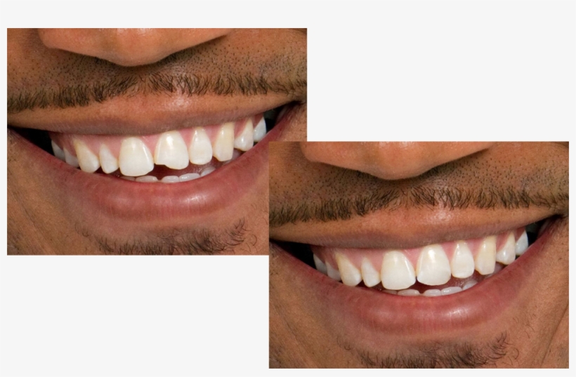 A Before And After Photo Of Dental Bonding - Dental Bonding, transparent png