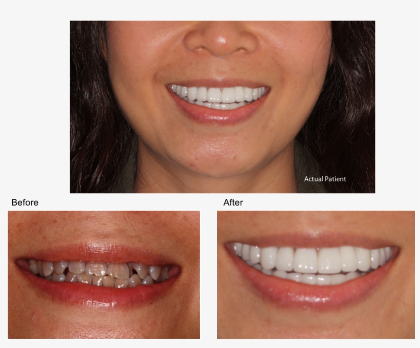 Tetracycline Solutions - Tetracycline Teeth Stain, transparent png