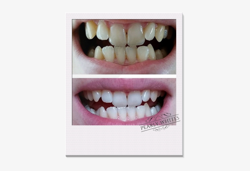 Teeth Whitening Before And After Photos From A Pearly - Home Teeth Whitening, transparent png