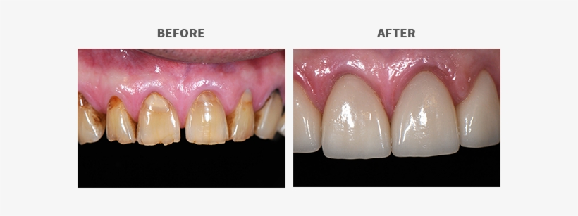 This Patient Suffered From Worn And Eroded Dentition, - Colorfulness, transparent png