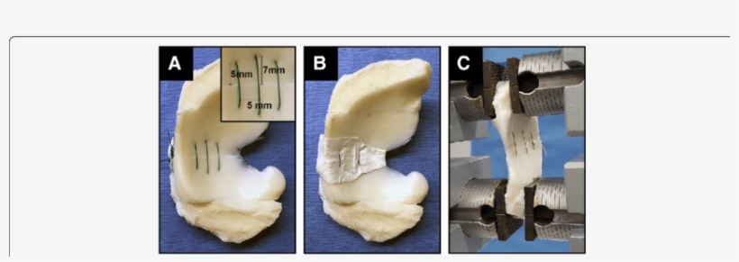 Suture Repair Of Meniscal Tears And Mechanical Testing - Tear Of Meniscus, transparent png