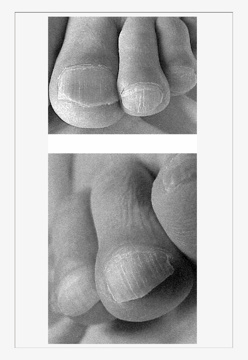 Case 2 - Graft, transparent png